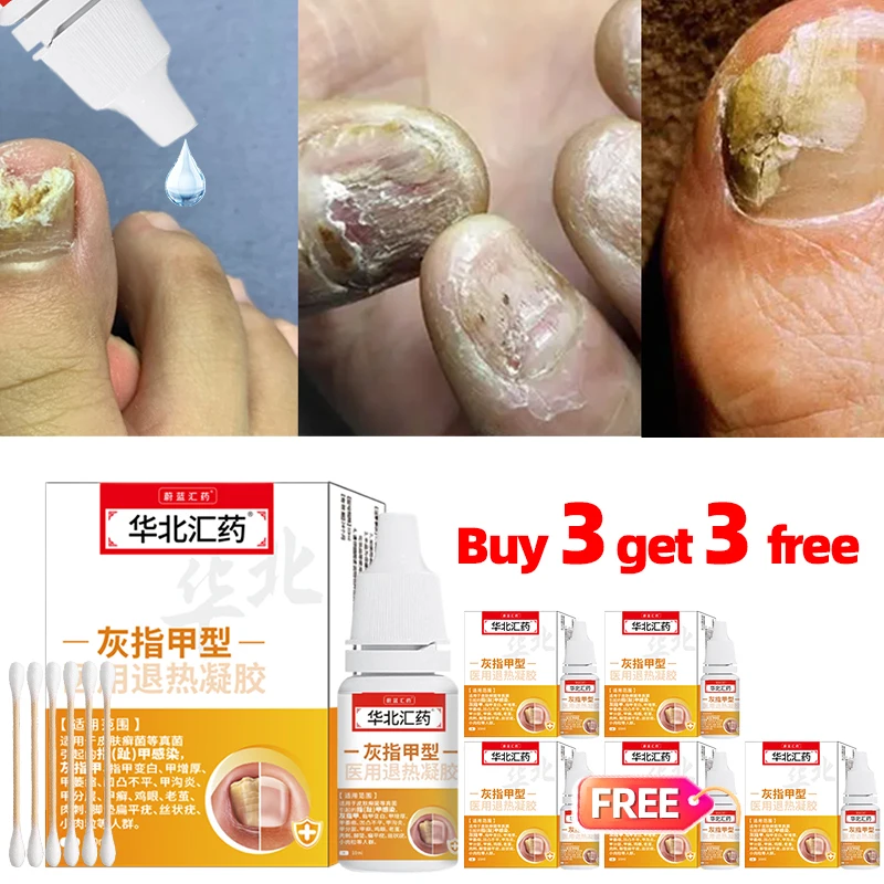 

6Boxes Fungal Nail Treatment Essence Oil Feet Nails Paronychia Repair Care Anti Infection Onychomycosis Removal Serum 10ml