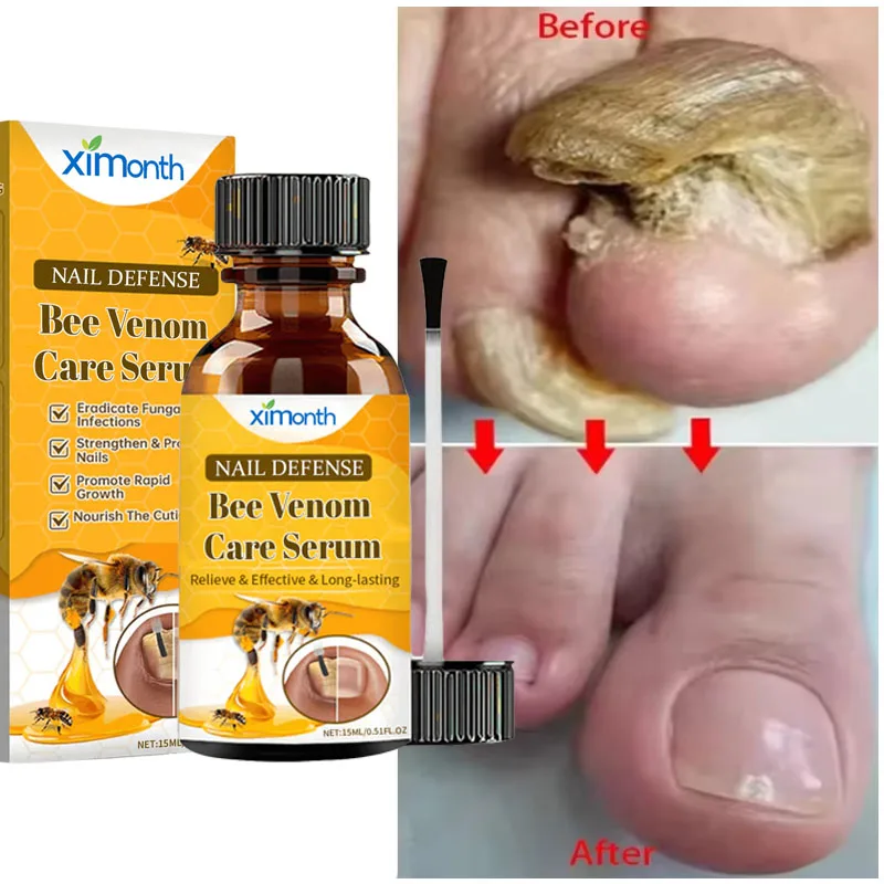 손발톱 무좀 치료 세럼 발가락 손발톱 무좀 제거 에센셜 오일 항균 손발톱진균증 손발톱 주위염 치료 관리