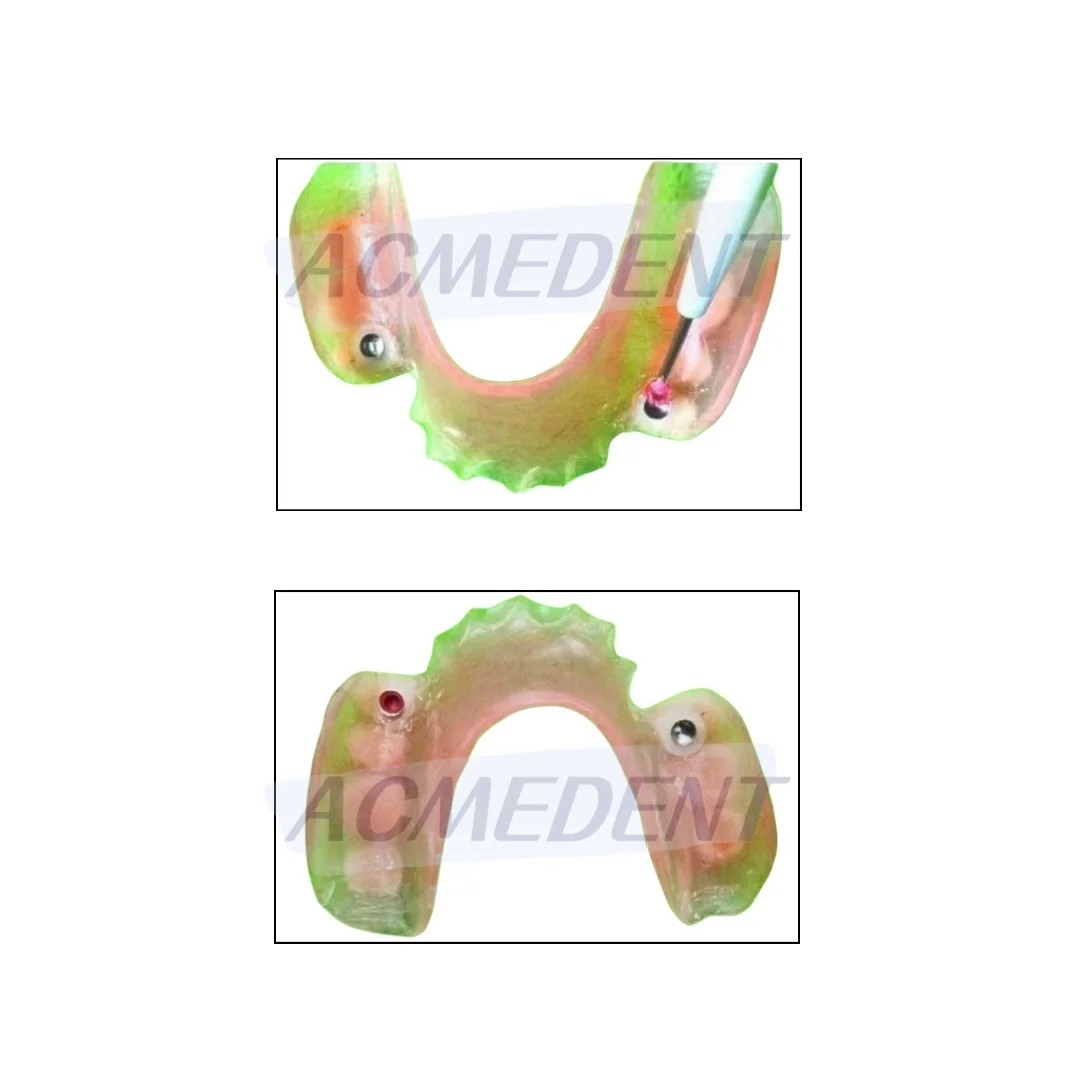 1Box Dental Overdenture Male Caps Castable Ball Metal Housing Retention Locator Style Abutment Negative Ball