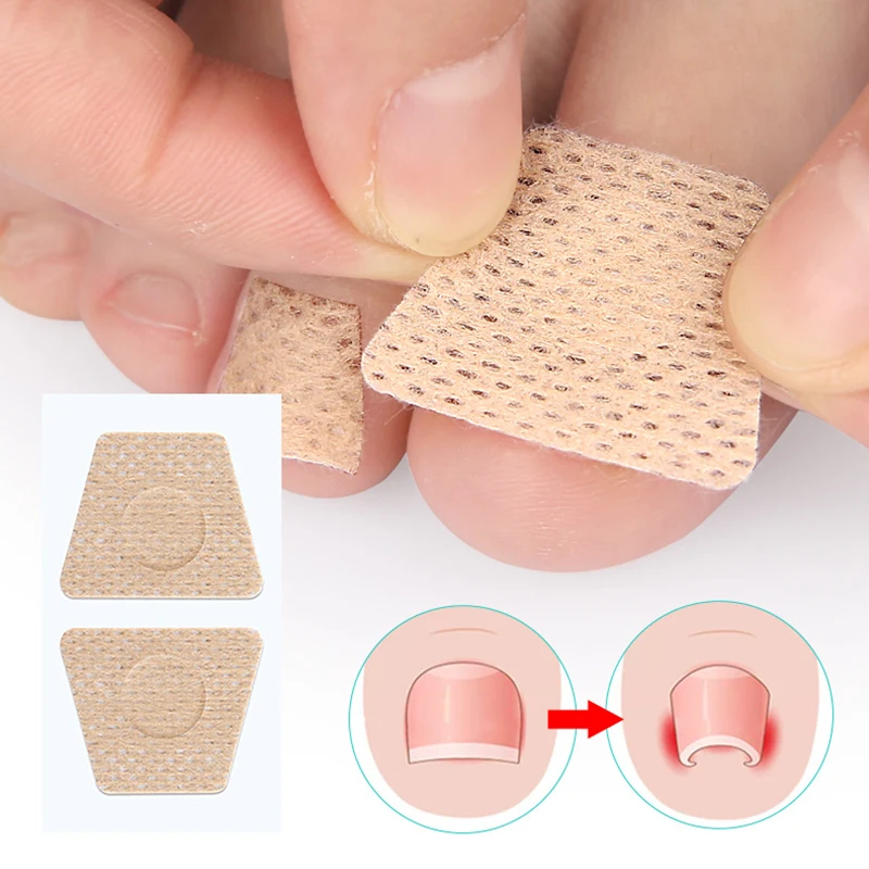 2/6/12Pcs Ingrown Toenail Toe Correction Stickers Nails Art Foot Patches Feet Care Paronychia Treatment Recover Pedicure Tools