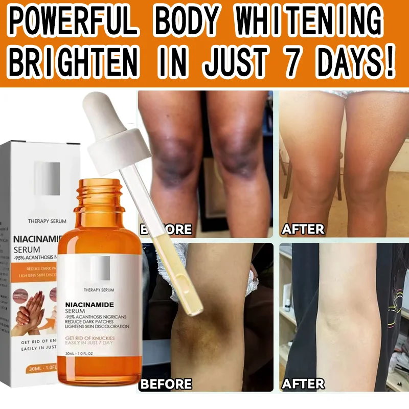 

Отбеливающая сыворотка для темных суставов локтей, подмышек, пляжная сыворотка, осветляющая интимная часть кожи, удаление интимных частей, темные пятна, меланин