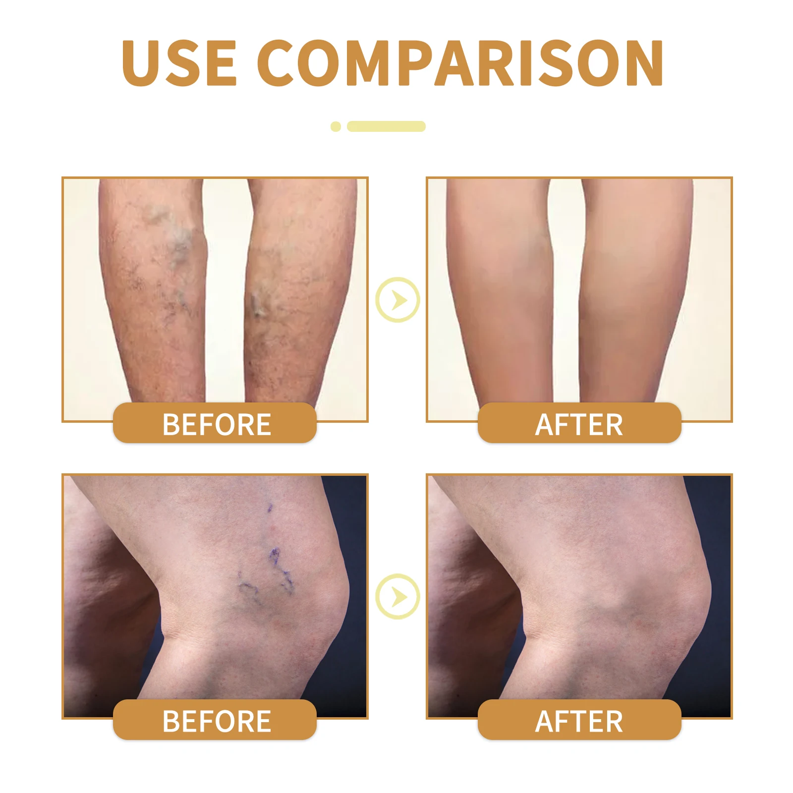 كريم فيتامين K الدوالي يسرع الدورة الدموية ويهدئ بشرة الساقين ويقوي الأوعية الدموية ويحافظ على ترطيبها #4