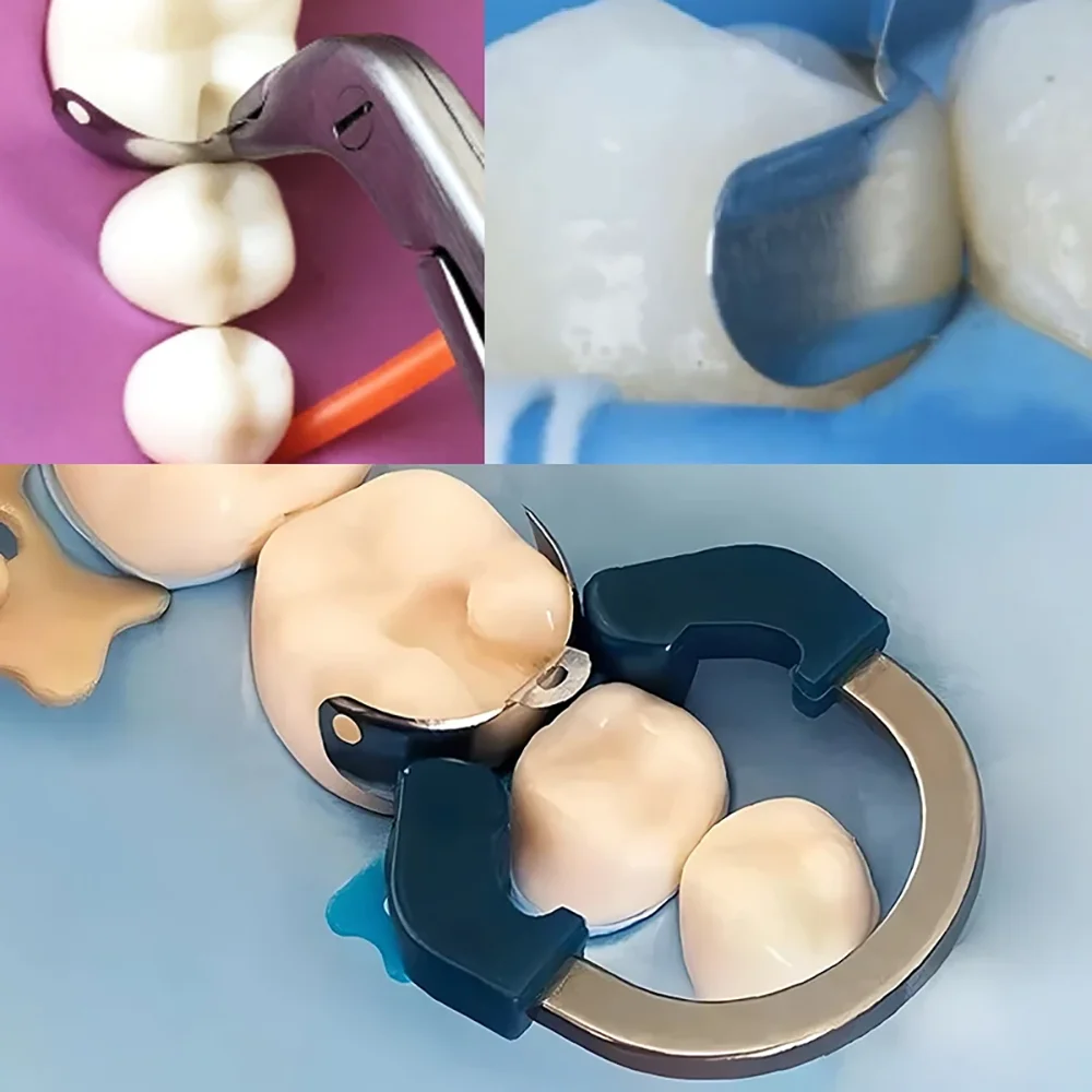 Dental Matrix Bands Set with NiTi Rings - Sectional Contoured Matrix System for Molar & Premolar Restorations