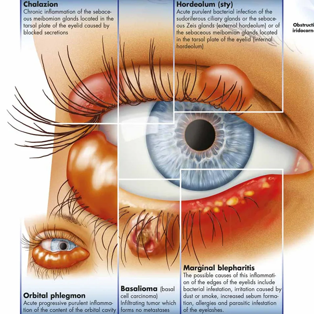 Diseases of the Eye Posters Prints Wall Chart Human Anatomy Picture Wall Art Canvas Scroll Painting Hospitals Clinics Home Decor
