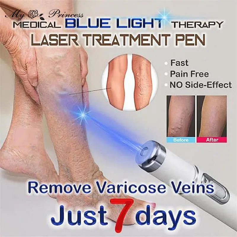 Hot Heath Blue Light Therapy Varicose Veins Treatment Laser Pen Soft Scar Wrinkle Removal Treatment Acne Laser Pen Massage Relax