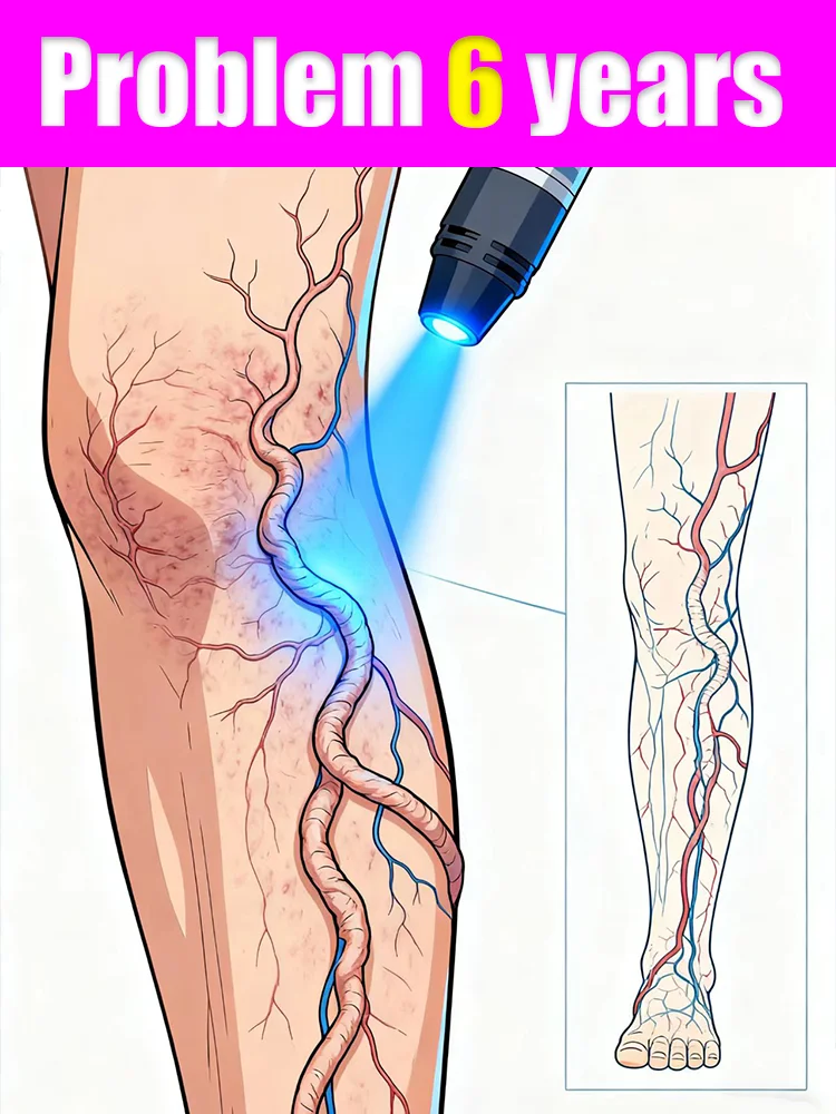 

The latest anti-varicose vein tool is equipped with a blue light pen.