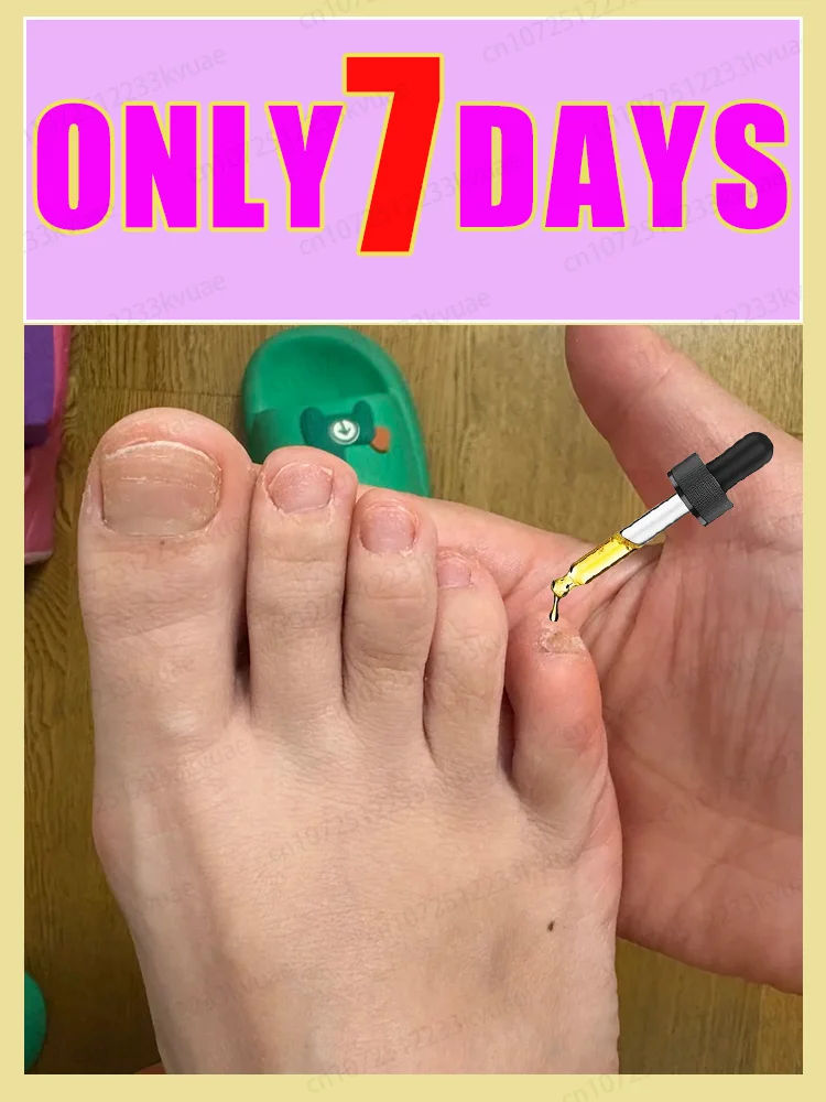 

Nᴀɪʟ ғᴜɴɢᴜs ᴛʀᴇᴀᴛᴍᴇɴᴛ ᴇssᴇɴᴛɪᴀʟ ᴏɪʟ, ʀᴇᴘᴀɪʀ ᴏɴʏᴄʜᴏᴍʏᴄᴏsɪs ɪɴ 7 ᴅᴀʏs