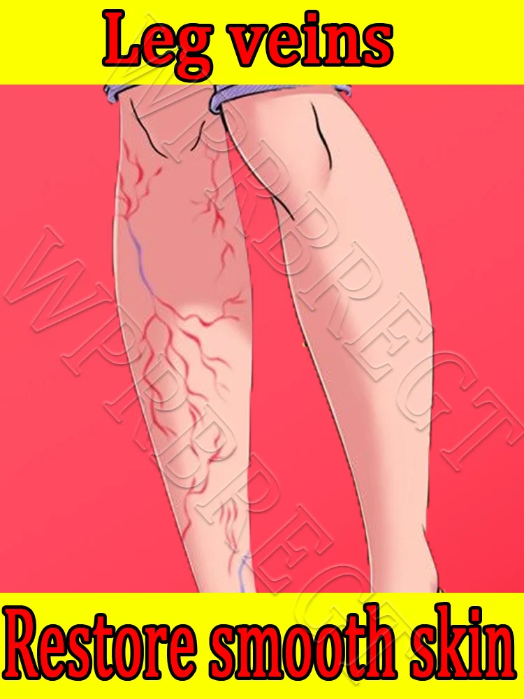 

Удаление варикозного расширения вен из тела.