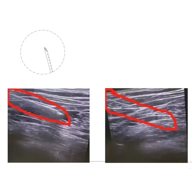 High Quality Disposable Echogenic Needles for Nerve Block Peripheral Procedures