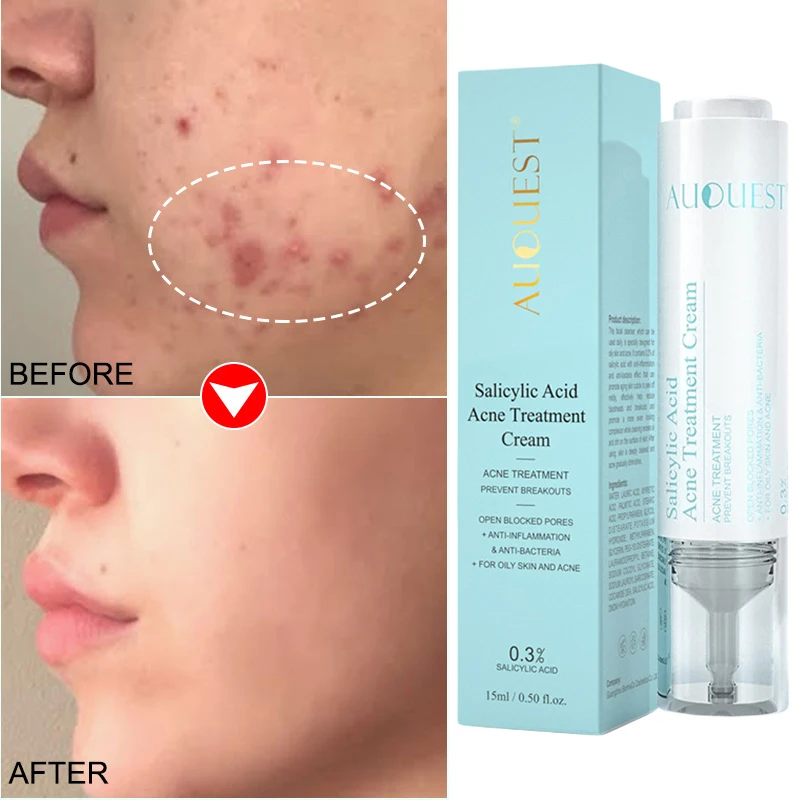 

Salicylic Acid Face Cream Blackhead Redness Remover Acne Treatment Pore Shrinking Serum Moisturizer Korean SkinCare Cosmetic15ml