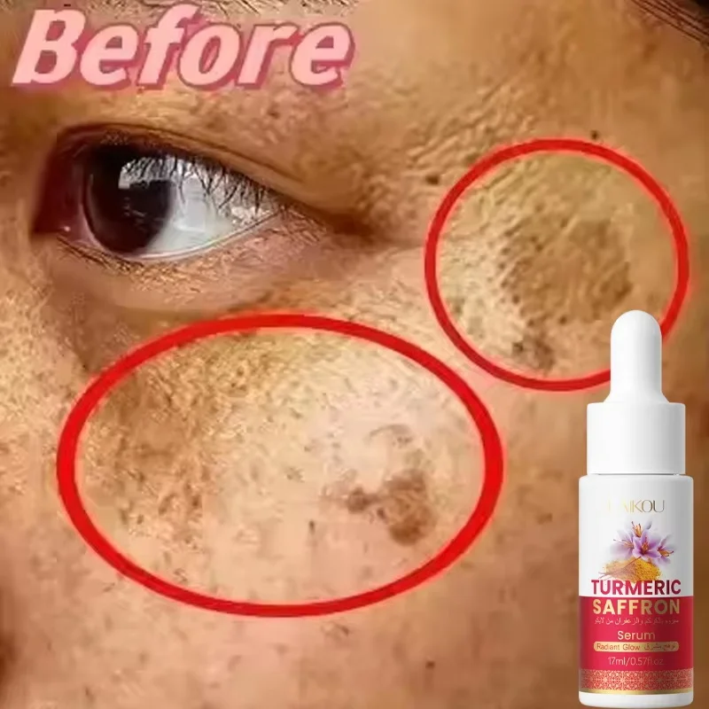 Turmeric Freckle Removing Whitening Essence Fade Pigmentation Melasma Dark Spots Corrector Repair Serum Korean Skin Care