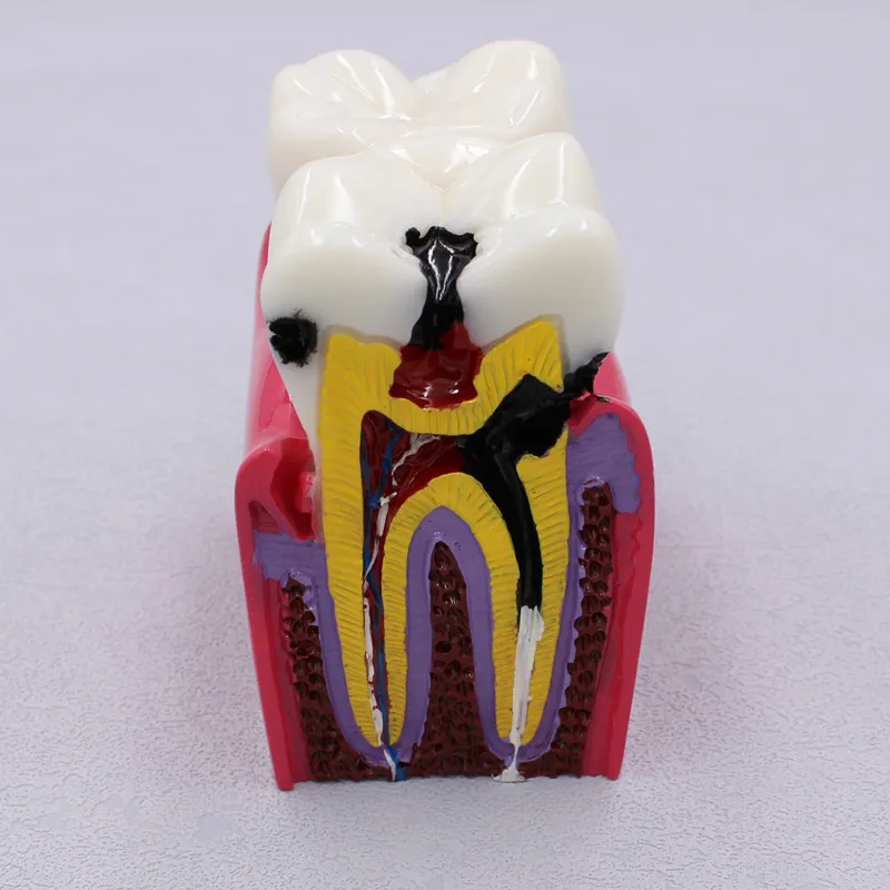 1 Pc Dental material laboratory dental model with 6 caries comparisons: a model for doctor-patient communication