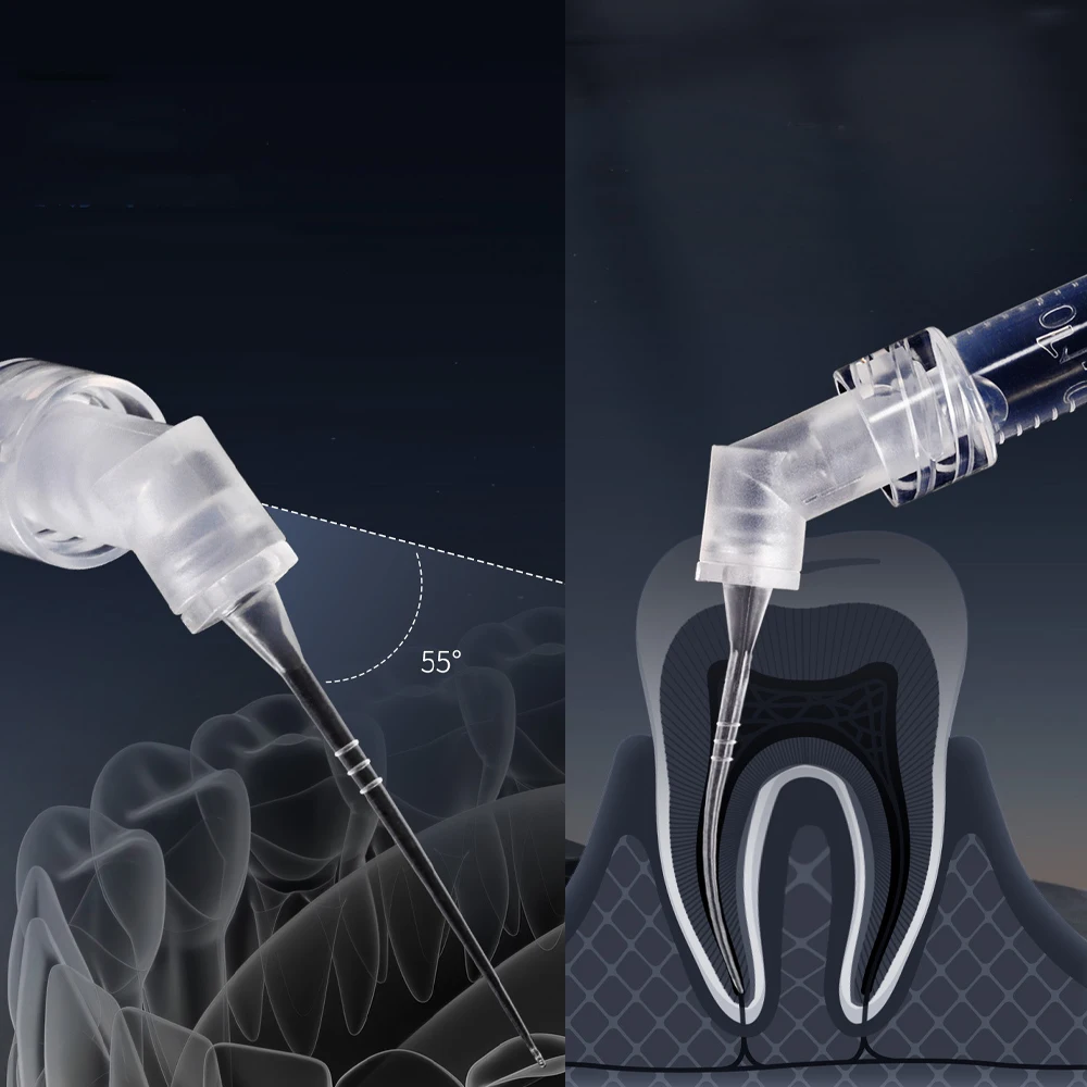 Aiguille d'irrigation endodontique dentaire 30G, pointe d'irrigation latérale pour canal radiculaire, embout de rinçage dentaire, diamètre 0,3 mm