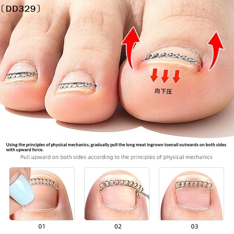 12Pcs/Box Ingrown Toe Nail Corrector Spring Wire Fixer Pedicure Recover Straightening Clip Patch Toenails Orthotic Foot 〔DD329〕