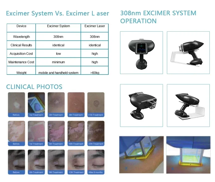 2022 High Quality Unlimited time Vitiligo Laser UV Lamp Phototherapy Excimer Laser 308nm