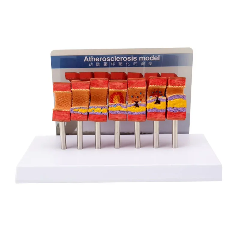 

7-Stage Arterial Vessel Atherosclerosis Model Detachable Blood Vessel Structure Anatomia Model Medical Teaching Educational Tool