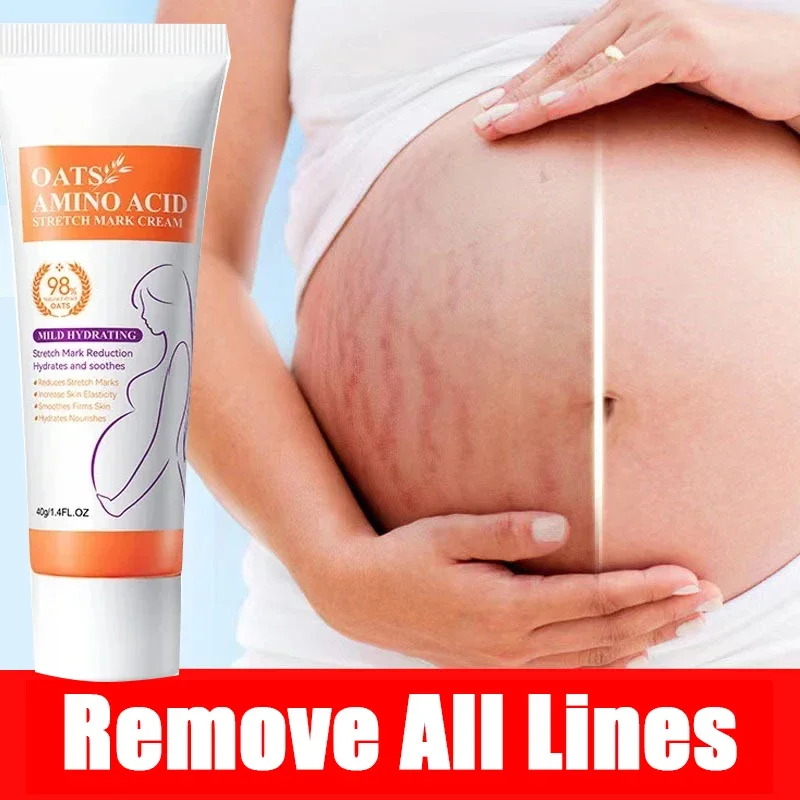 Pregnancy Repair Stretch Mark Removal Acne Scar Maternity Stretch Marks Remove Fat Striae Scars Treatment skin Care