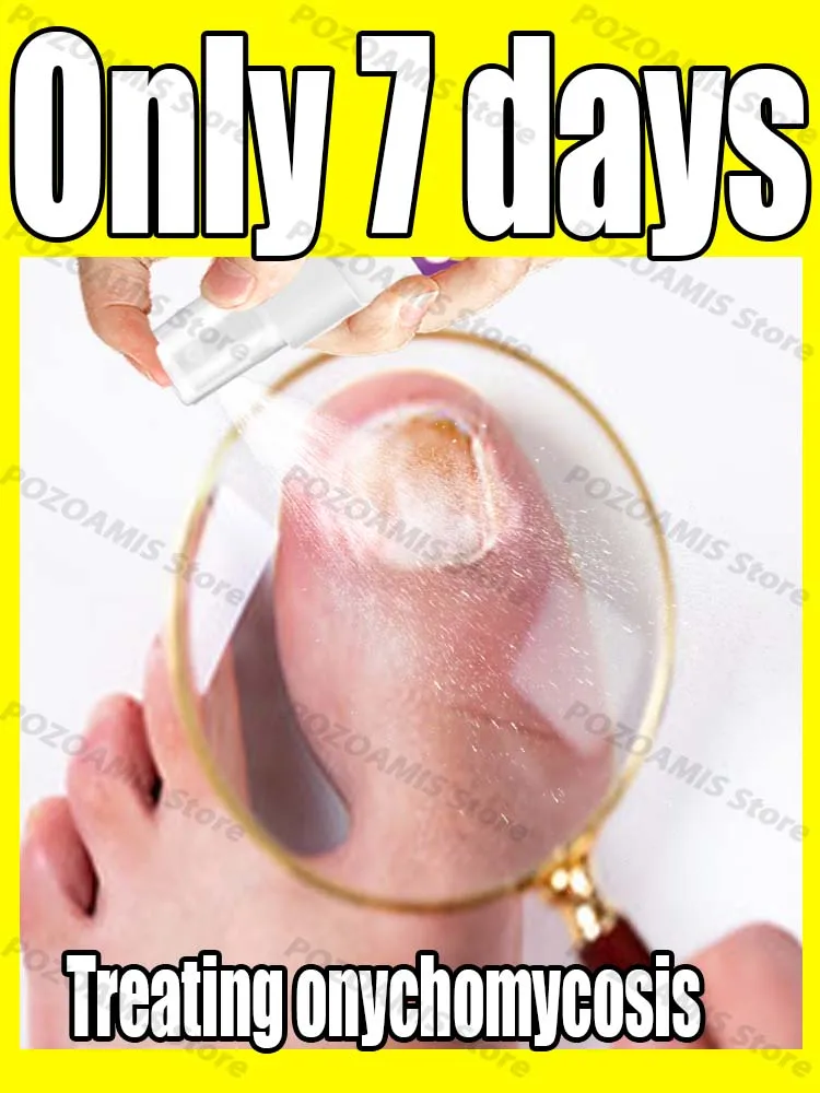 Spray per onicomicosi, facile da usare ovunque e ovunque, continua l'utilizzo e l' onicomicosi non recupererà!