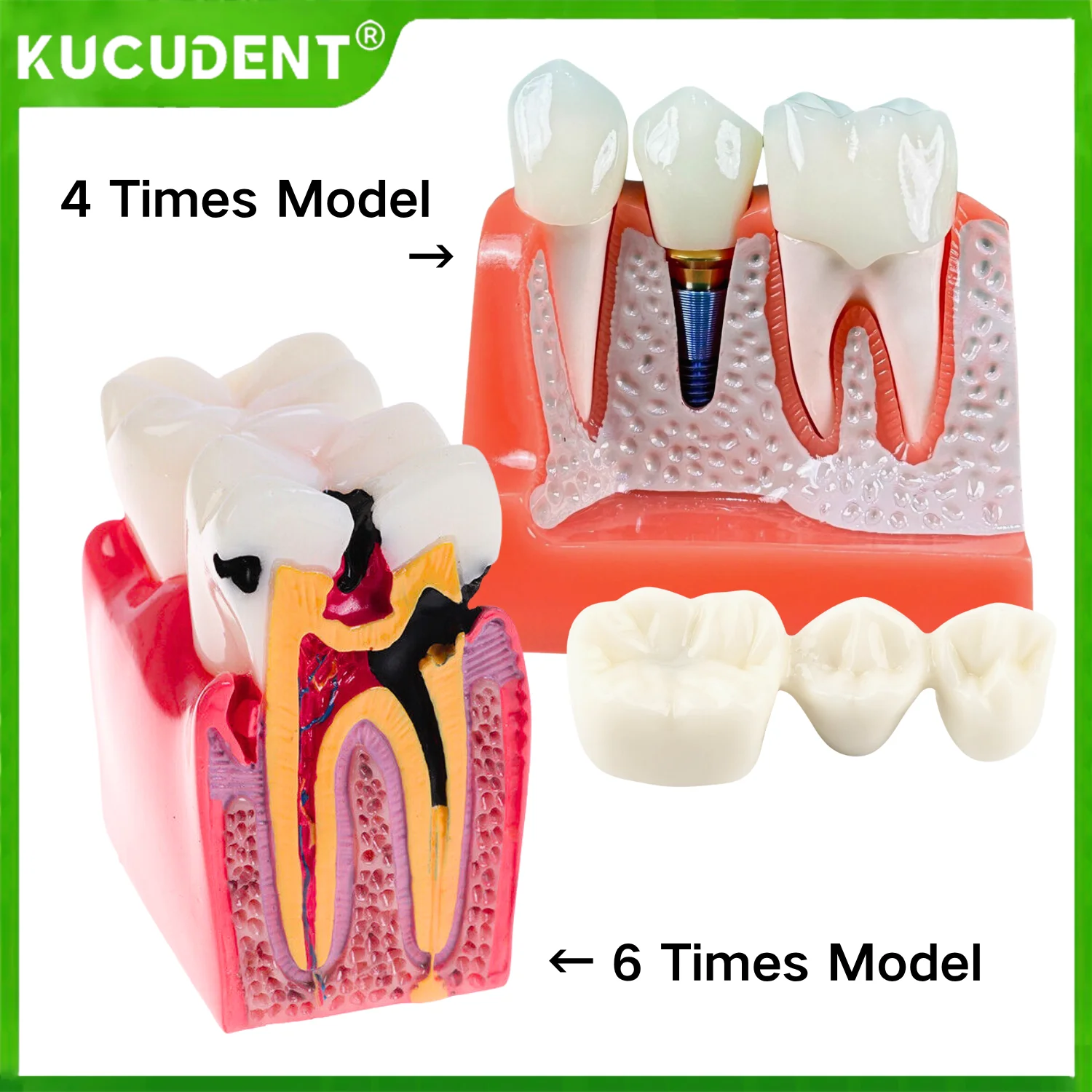 

Стоматологическая 4-кратная модель зубов с имплантатом, съемный анализ, корончатый мост для обучения, обучения, демонстрационный инструмент для стоматолога
