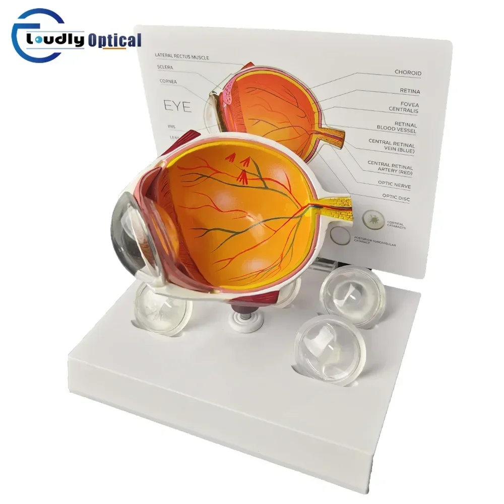 4X Cataract Eyeball Model Shows Internal Structure of The Eye Various Cataracts Anatomy Teaching and Patient Demonstration