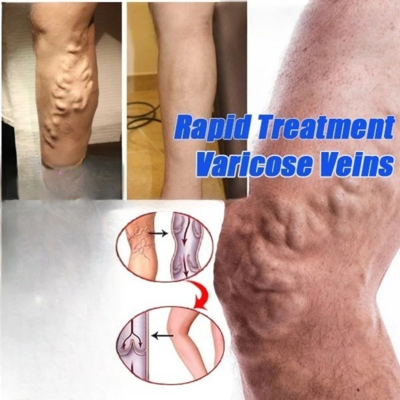 Varicose Veins Eliminate Vasculitis Phlebitis To Relieve Spider Leg Pain Treatment Herbal Cream