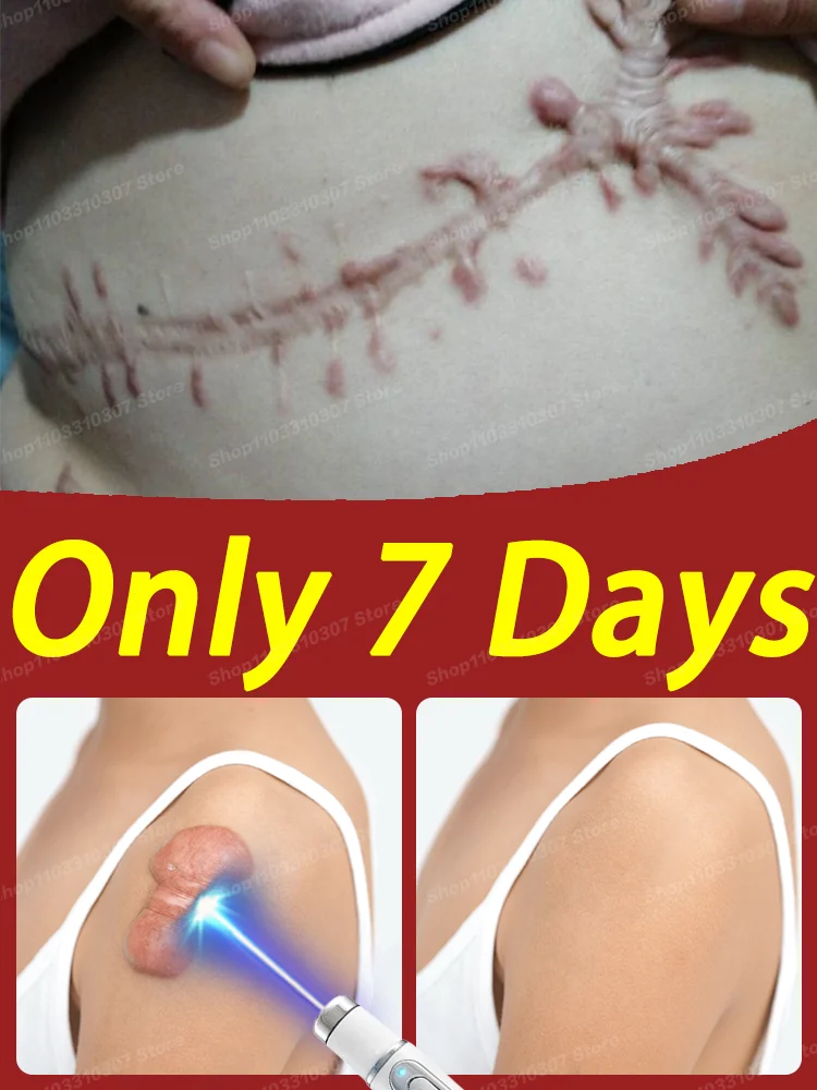 

Keloid Scar Fast Therapy
