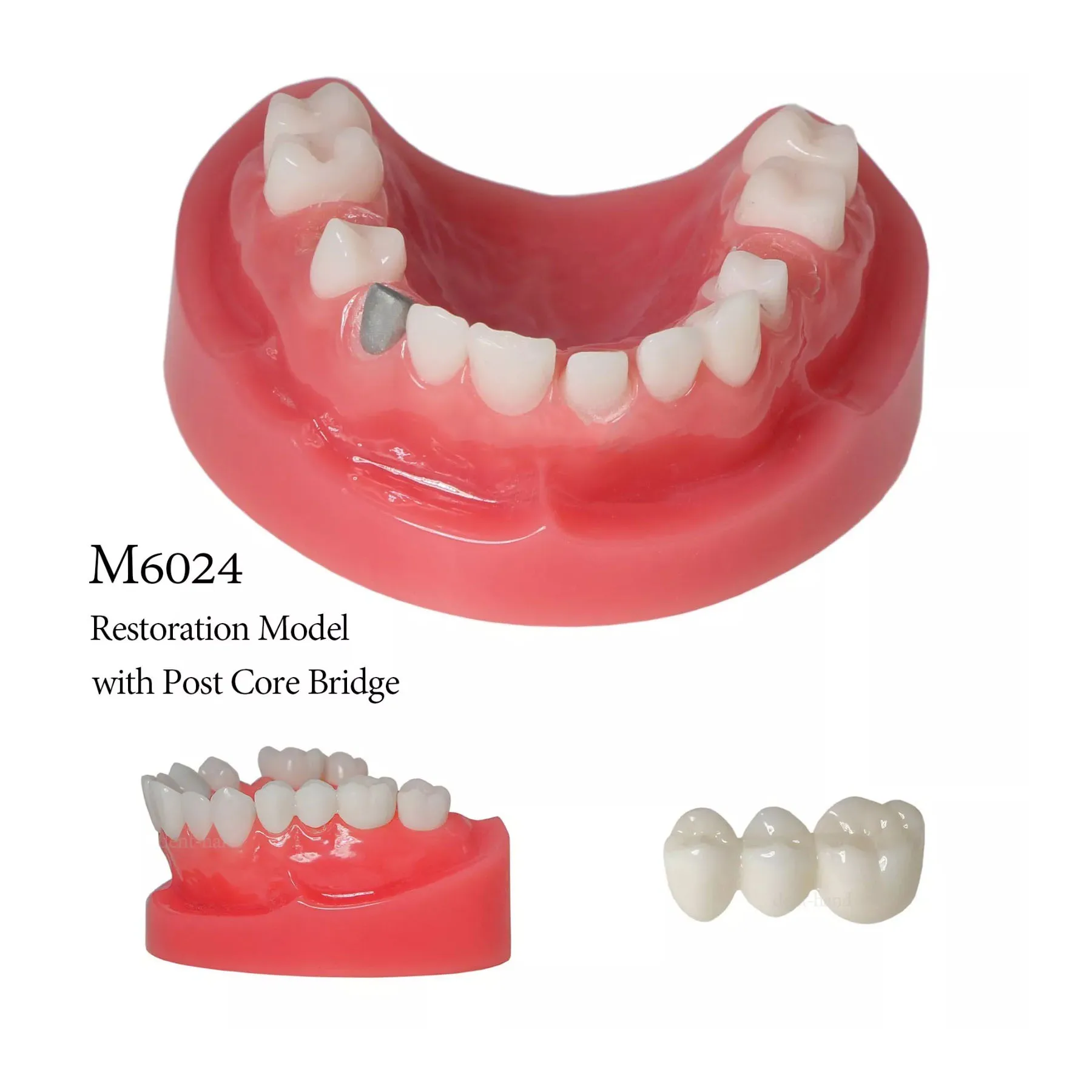 

M6024 Dental Implant Restoration Model Overdenture Teeth Model with Post Core Bridge