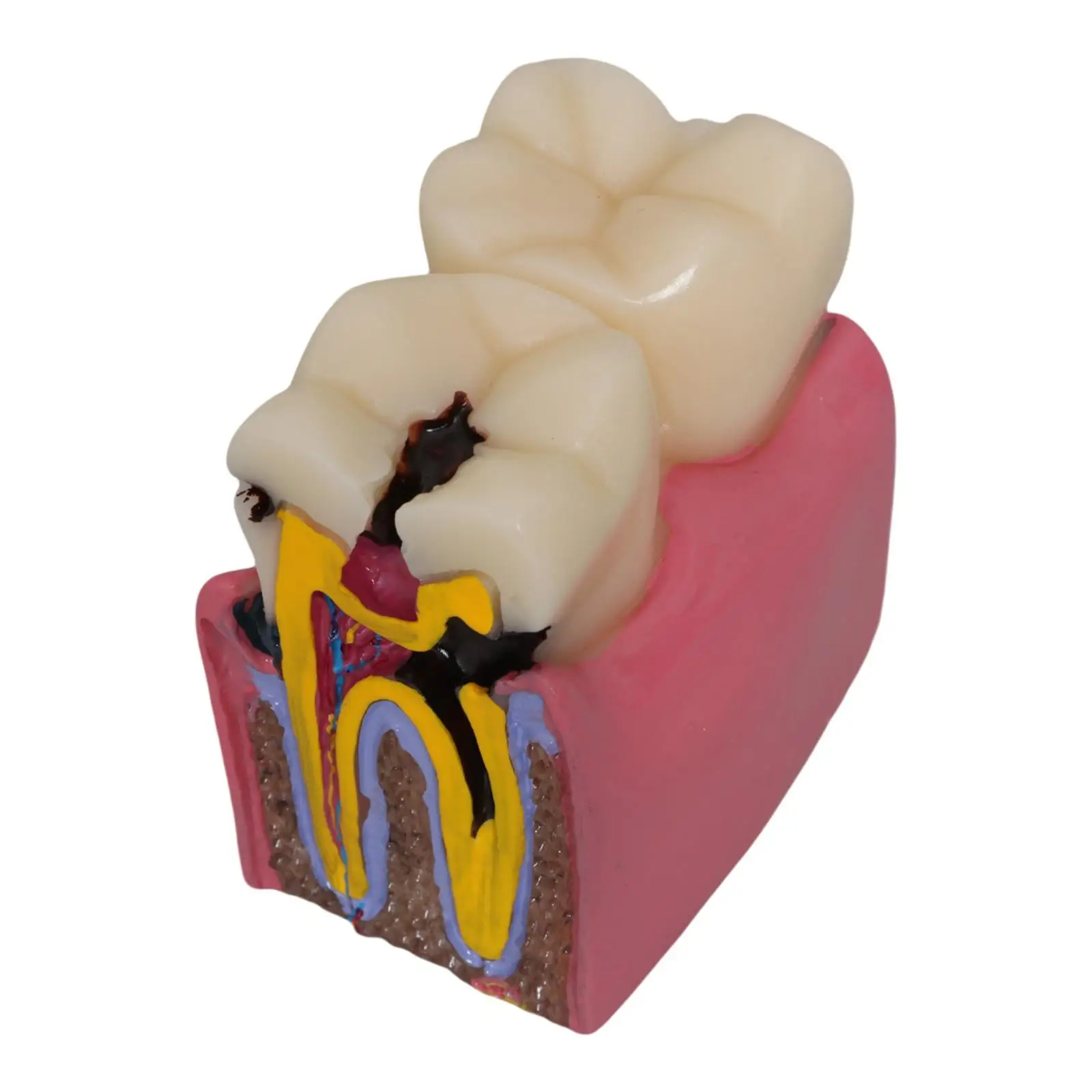 Caries Tooth Model 6 Times Teaching Prop Morphology, Resin ,Tooth Teaching Display for Studying Students Class Education Kids