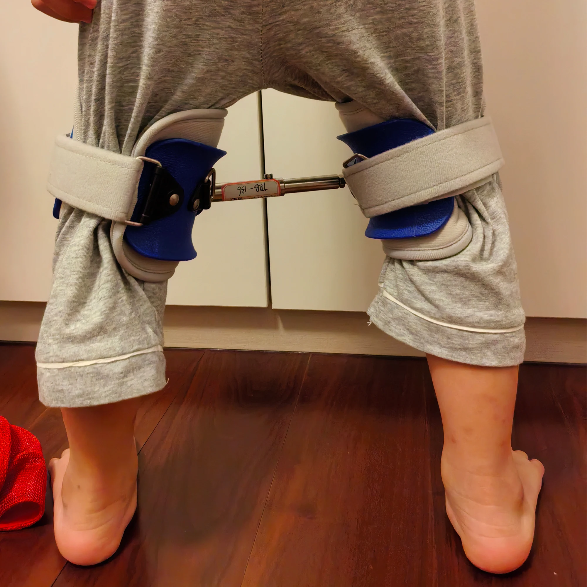 Customizable Child Pediatric Bar Hip Abduction Orthosis for Developmental Dysplasia of The Hip and Congenital Hip