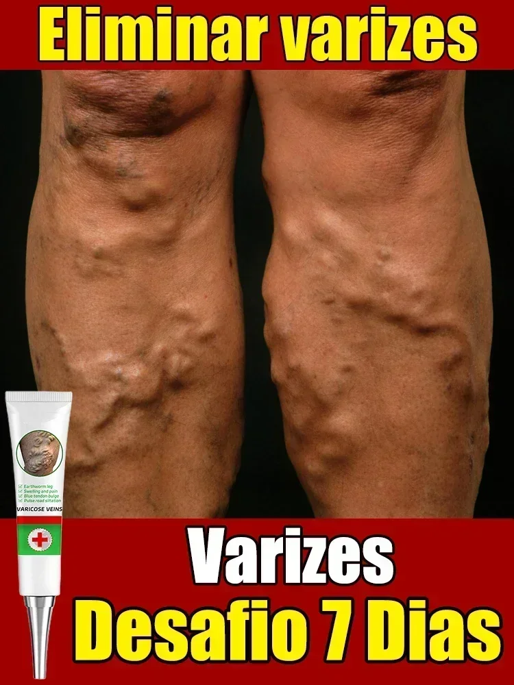 Effective varicose vein soothing cream. Vasculitis, phlebitis, spider leg soothing cream