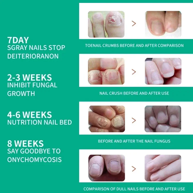 Nail Fungus Tratamento Soro, Remoção De Óleo De Essência, Pés Pregos, Anti Infecção, Toe Fungal Repair, Cuidados Com O Corpo, Creme De Essência