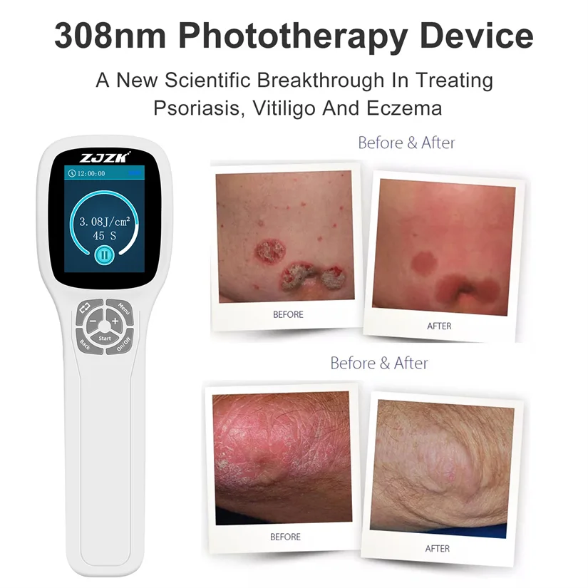 308nm UV Light Treatment for Vitiligo Dermatitis Psoriasis Best Light Therapy for Eczema UV Light Machine for Skin Conditions