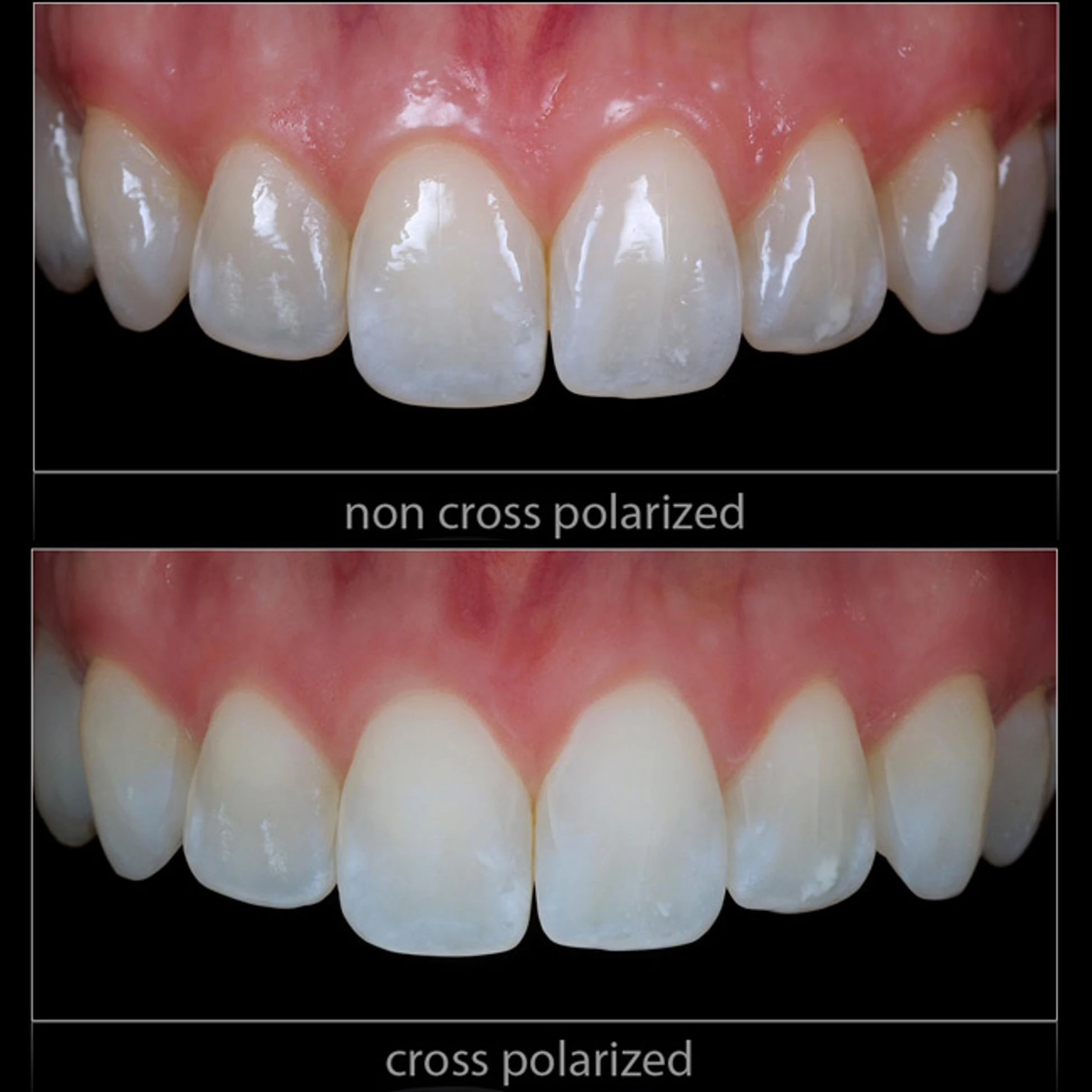 Dental Photography Without Reflections And Glare - Dental Cross Polarization Photo For Dentist - Polar Eye For MEIKE MK-14 Flash