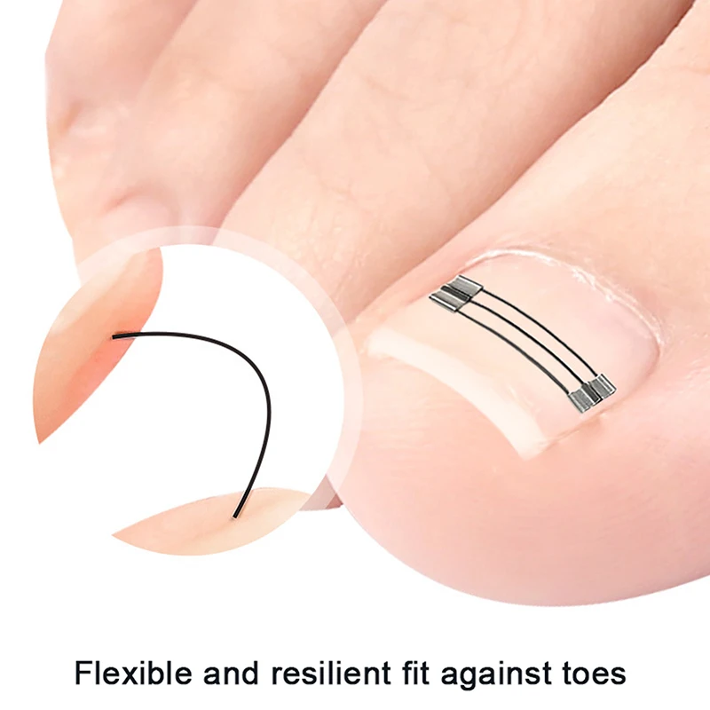 Corrector de uñas encarnadas, herramientas de sujeción, recuperación de pedicura, tratamiento de uñas encarnadas profesional, alisado de uñas encarnadas