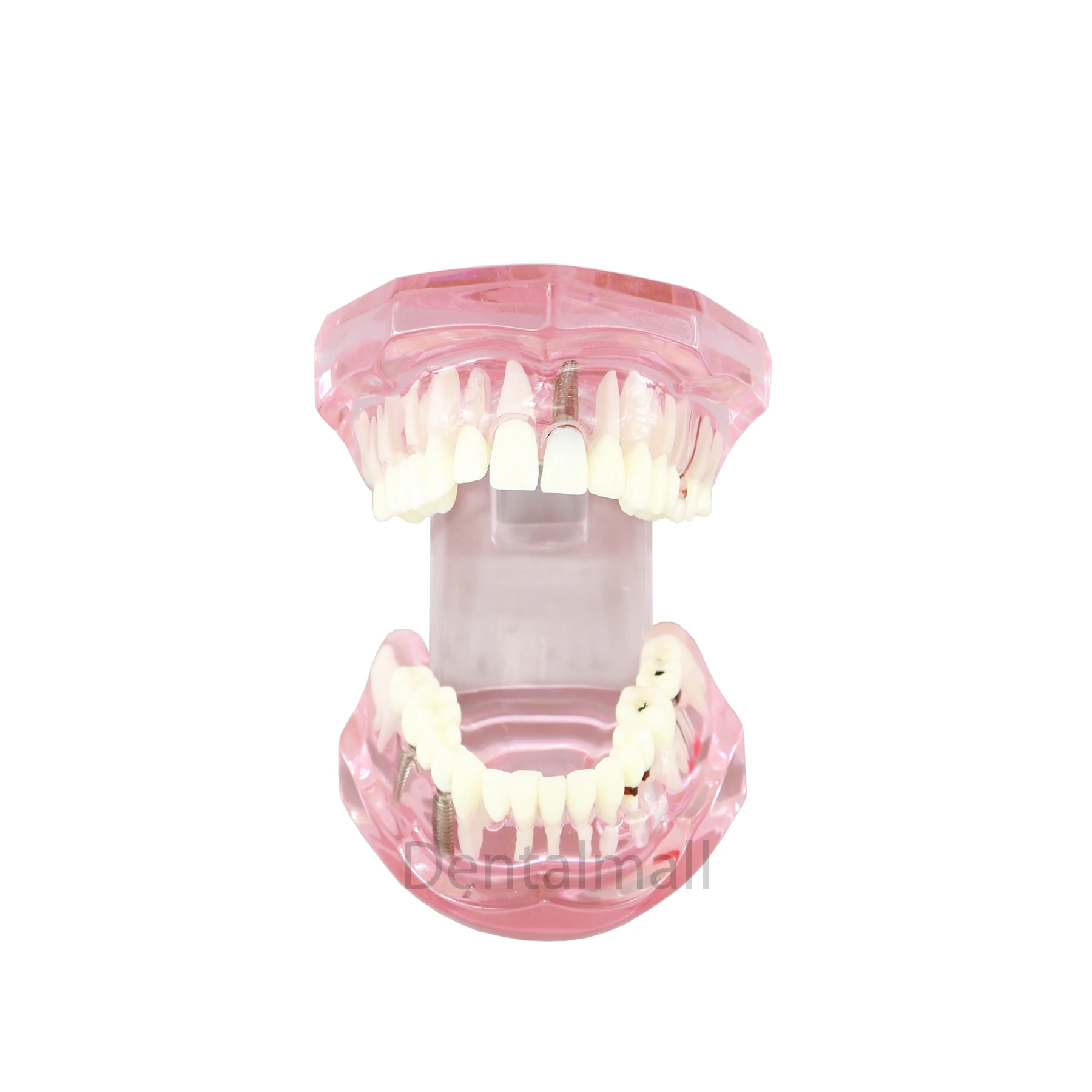 

Dental Teeth Model Restoration Teach Demo M2001P Implant Disease Model Bridge