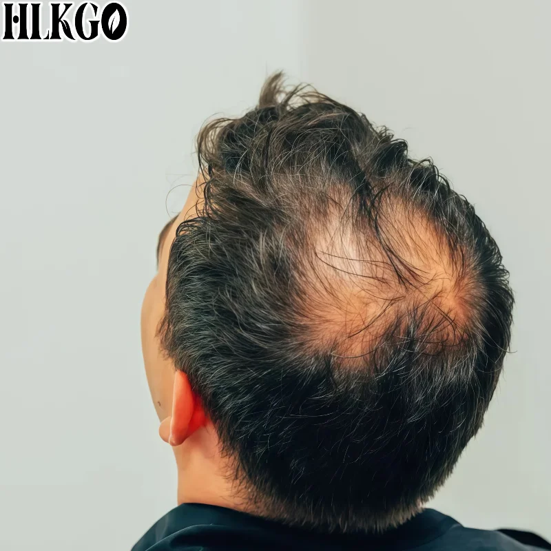 Medical Grade 650nm Low Level Laser Cap, 300-Diode Helmet for Hair Regrowth Thinning Hair Male Female Pattern Baldness