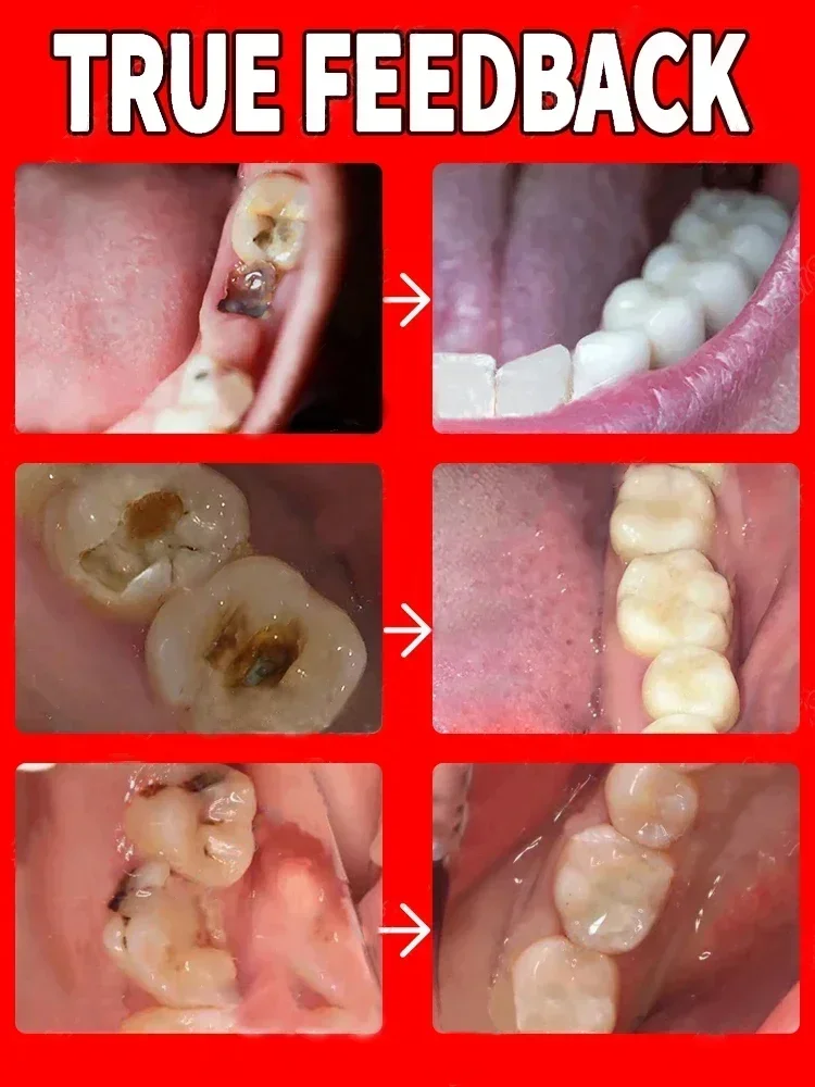 Blanqueamiento Dental fresco, elimina el mal aliento, placa, alivia el dolor de dientes