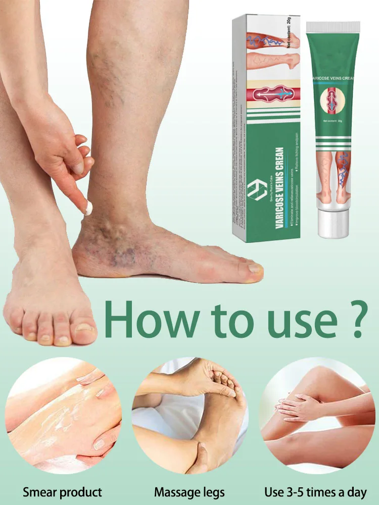 ointment for varicose veins Effective varicose vein relief cream to relieve vasculitis phlebitis spider pain treatment