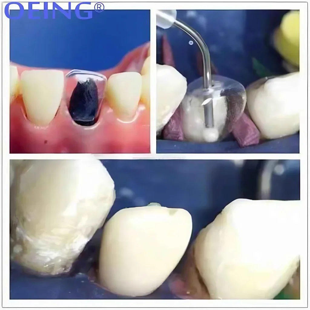 64pcs/Box Dental Transparent Crowns Adult Kids Dentist Kit 1.910/1.912  Temporary Preformed Posterior Pre-crown Matrices Matrix