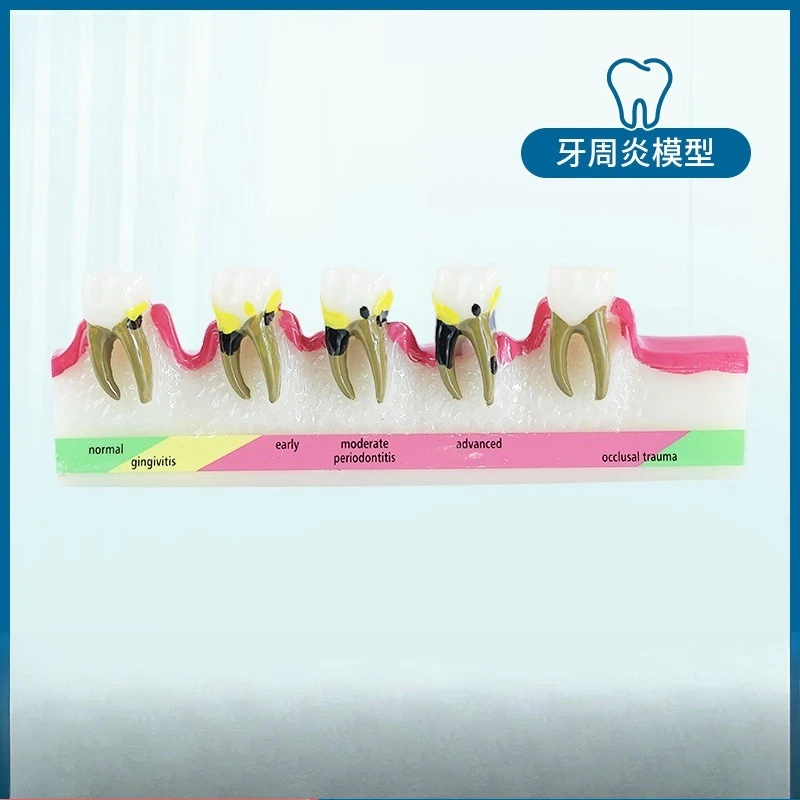 Periodontitis model resin adult periodontal evolution tooth model oral dentistry display teaching ornament