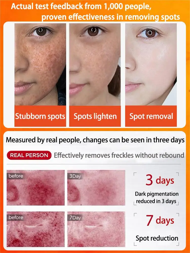 Eliminador de manchas oscuras, pecas, Melasma, cara