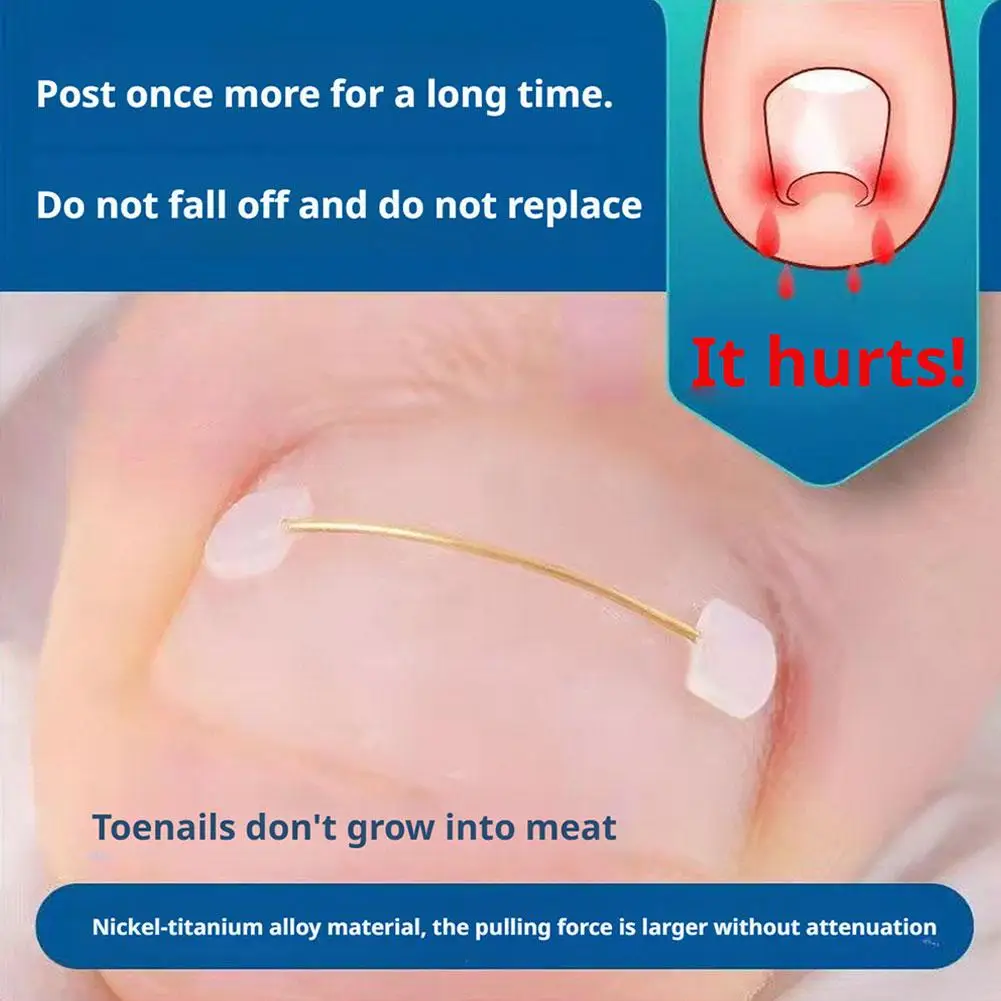 Orthodontic Braces with Steel Wire Buckles, Biomimetic Bone Memory, And Metal Inlay for Correcting Nail Inflammation