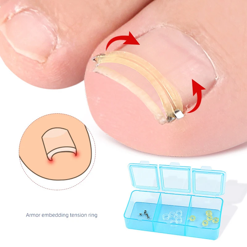 1 set correttore dell'unghia del piede incarnita pedicure recuperare incorporare trattamento delle unghie dei piedi professionale correzione del piede adesivi patch strumento di cura