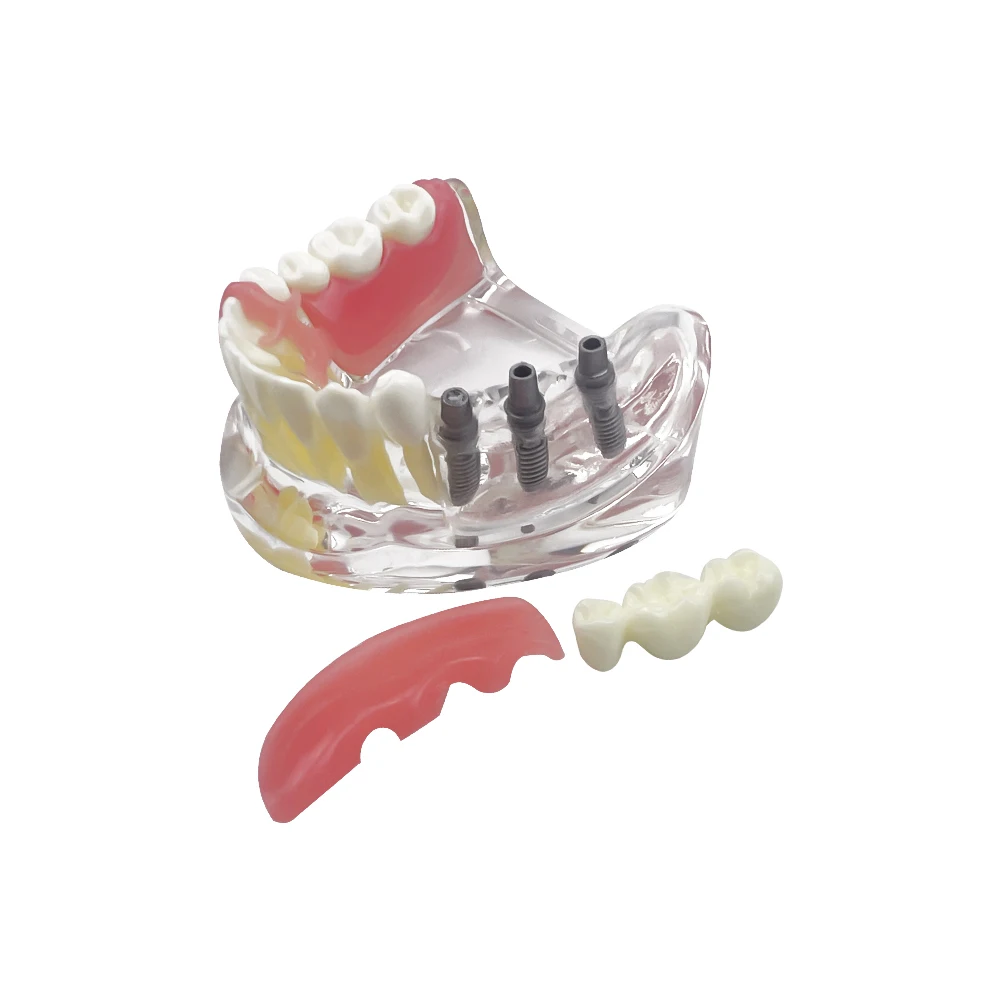 Dental Implant Model with Restoration Mandibular Implant Teaching Model for Dentist Technician Oral Medical Dentistry Equipment