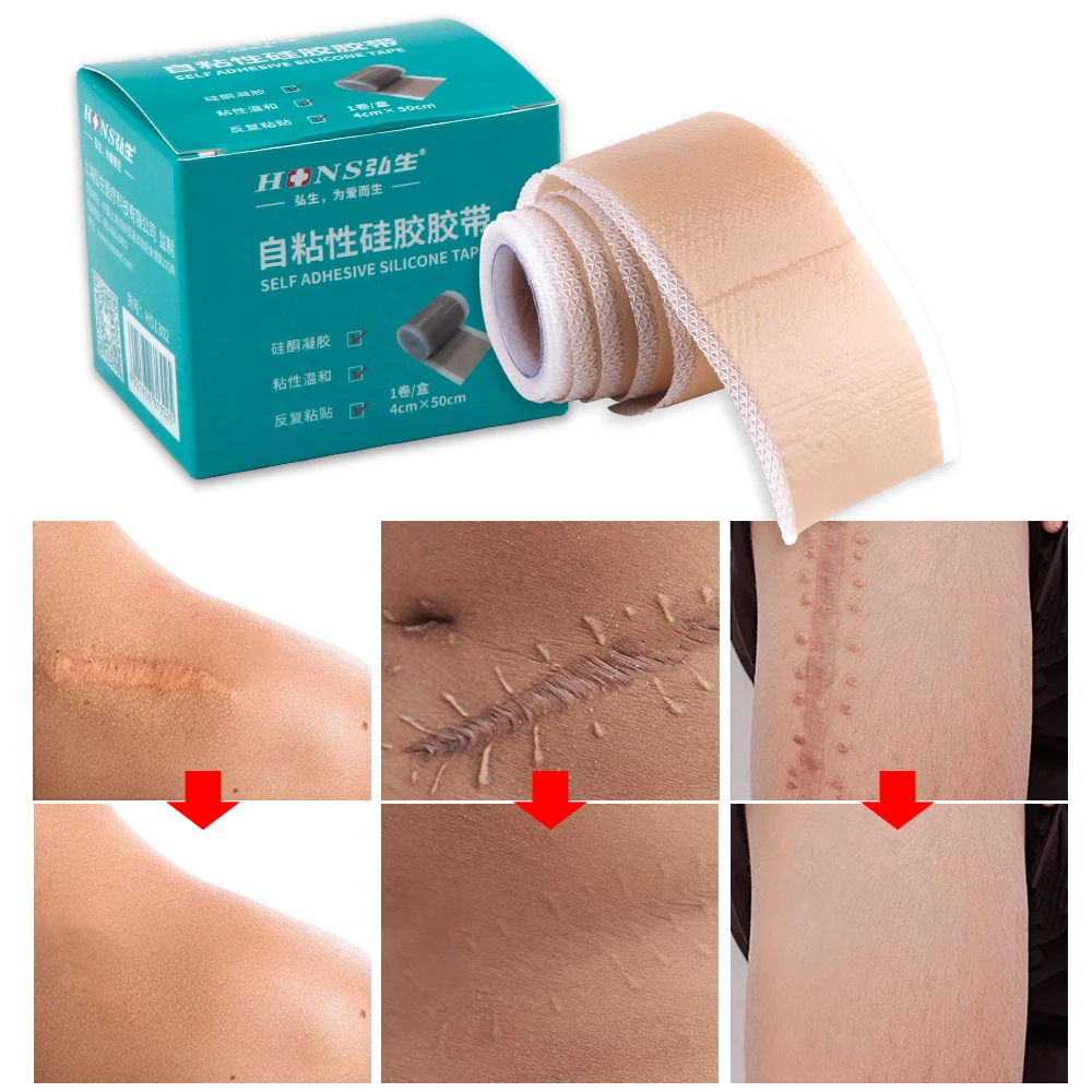 4x50cm Silicone Scars Patch Wounds Band Remove Acne Burn Scar Treatment Cover Ear Correctors Efficient Repair Damaged Skin Sheet