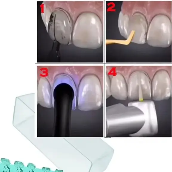 

Набор для формирования зубных виниров: композитные и фарфоровые виниры, эстетические формы, инструмент для отбеливания передних зубов