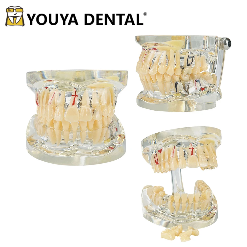 

Teeth Teaching Model Adult Pathological Model with Implant for Dentist Student Studying Doctor-patient Communication Tools