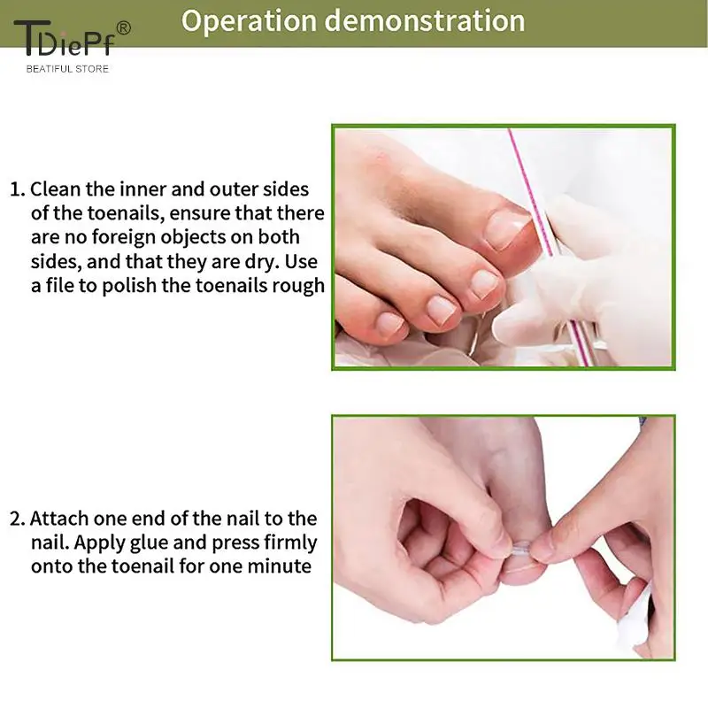 Ingrown Toenail Corrector Tools Pedicure Recover Embed Toe Nail Treatment Professional Ingrown Toenail Correction Foot Care Tool