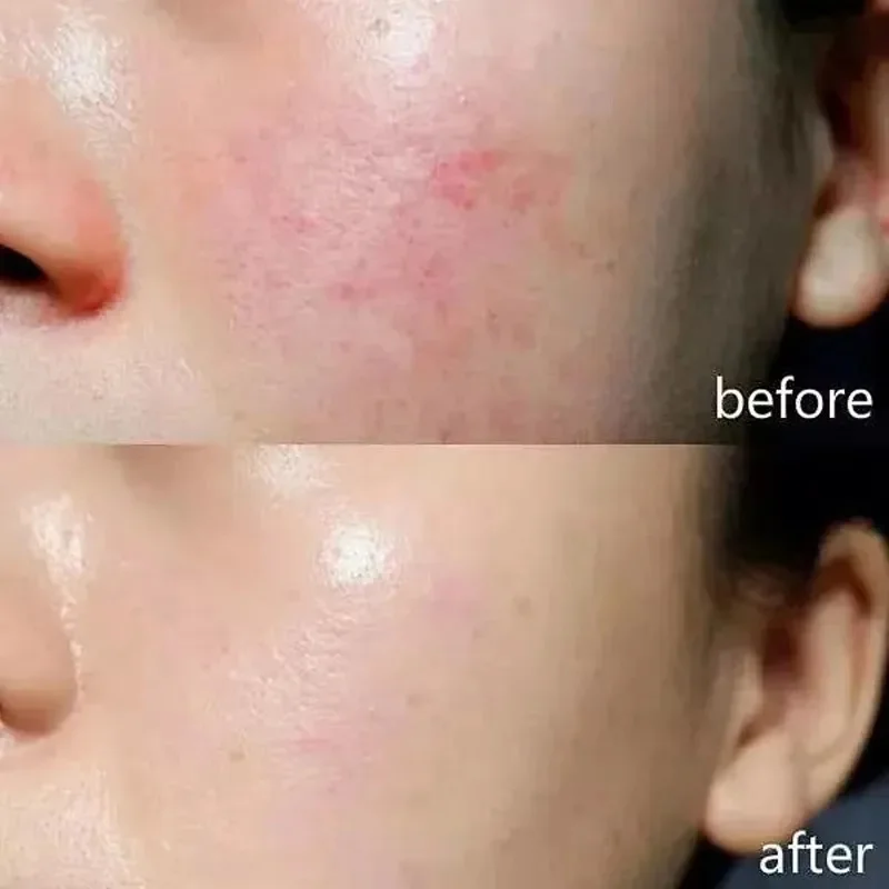 페이셜 레드니스 리페어 크림 민감성 피부 건조함 개선 모이스처라이저 하이드레이팅 수딩 로션 제거 Rosacea 한국 화장품