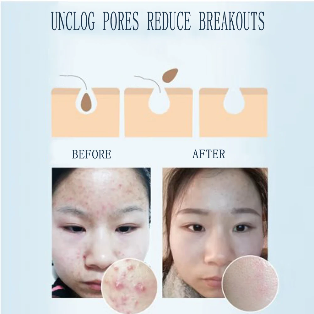 HANAJIRUSHI Acne Treatment Cleanser Remove Acne Face Wash Medicated Clear Facial Cleanser 60g